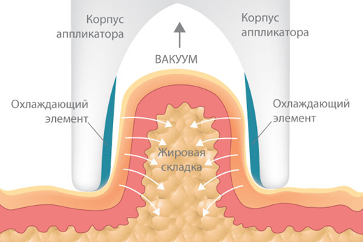 Криолиполиз